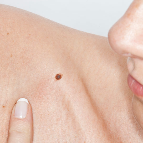 skin mole