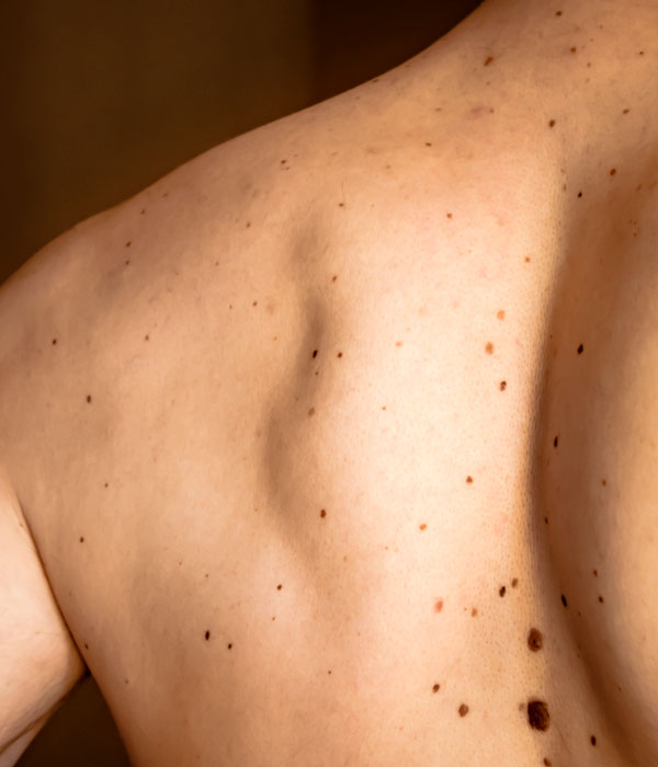 many moles on man's back