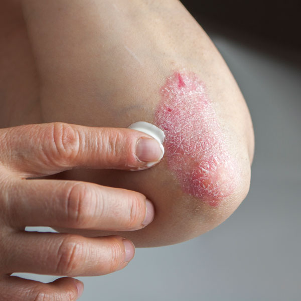 putting cream on skin rash